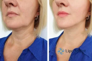 Double chin before and after Hi-Fu treatment 4 Book your double chin treatment Herefordshire today! We are here to help!