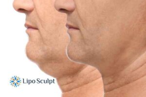 Double chin before and after Hi-Fu treatment 2 Double chin treatment Herefordshire from Lipo Sculpt - feel more confident today!