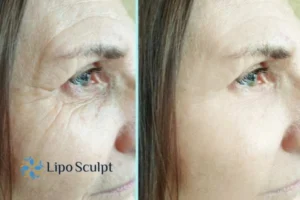 How to Fight Aging Symptoms 2 Do you want to Fight Aging Symptoms Herefordshire? Contact Lipo Sculpt today!