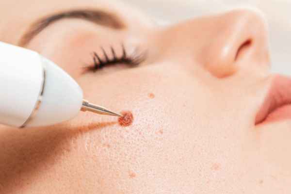 CryoPen: 5 Skin Concerns It May Be Used to Treat 3 What actually happens during a CryoPen treatment Herefordshire?
