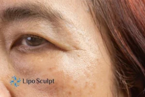 Cryopen: The Revolutionary Treatment for Age Spots Unveiled 2 Are age spots Herefordshire giving you low self esteem? Contact us today!