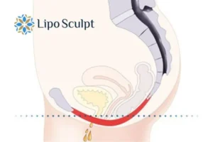 Pelvic Floor Chair Therapy 1 Pelvic Floor Chair Therapy Herefordshire to treat incontinence.