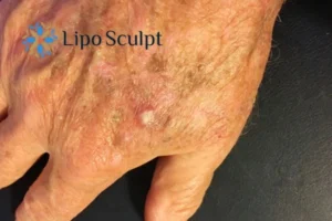 Best Actinic Keratoses Removal 2 Improve your wellbeing and health with Actinic Keratoses Herefordshire removal.treatment