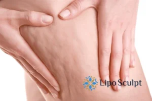 CoolSculpting for Legs: The Innovative Approach to Redefining Your Legs 5 Start your journey today book your coolsculpting treatment Herefordshire online today!