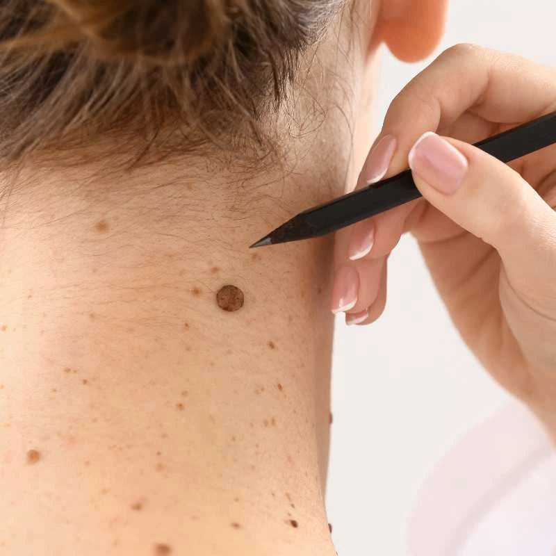 How to Support Your Body During Pregnancy for Faster Postnatal Recovery 5 See our lesion removal prices Herefordshire - call today for a free quote