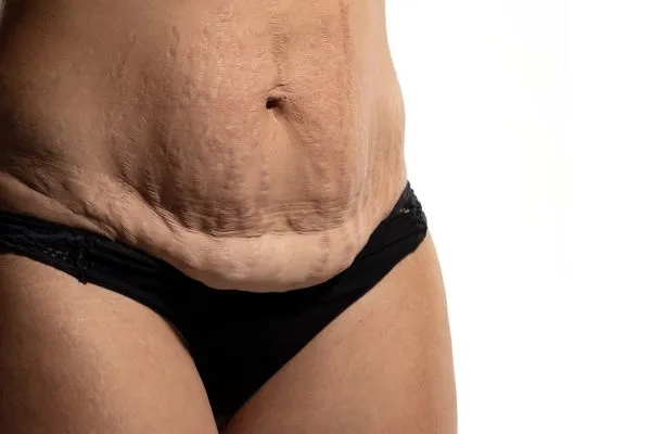 Lost the Weight but Not the Loose Skin? 1 image of womans stomach after weight loss showing loose skin Herefordshire